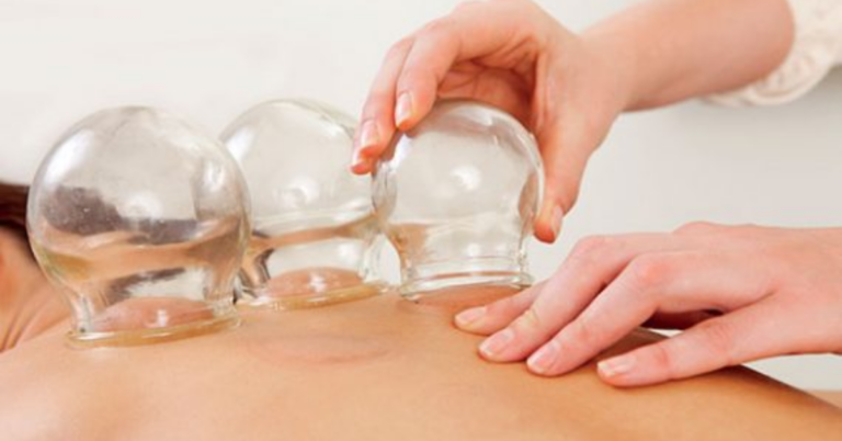 Unlocking Wellness: The Benefits of TCM Cupping Therapy in Singapore